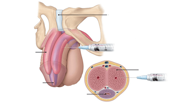 Injection de votre propre tissu adipeux pour augmenter l'épaisseur du pénis